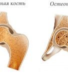 нормальная кость и остеопороз