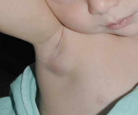 Увеличенный подмышечный лимфоузел у ребёнка