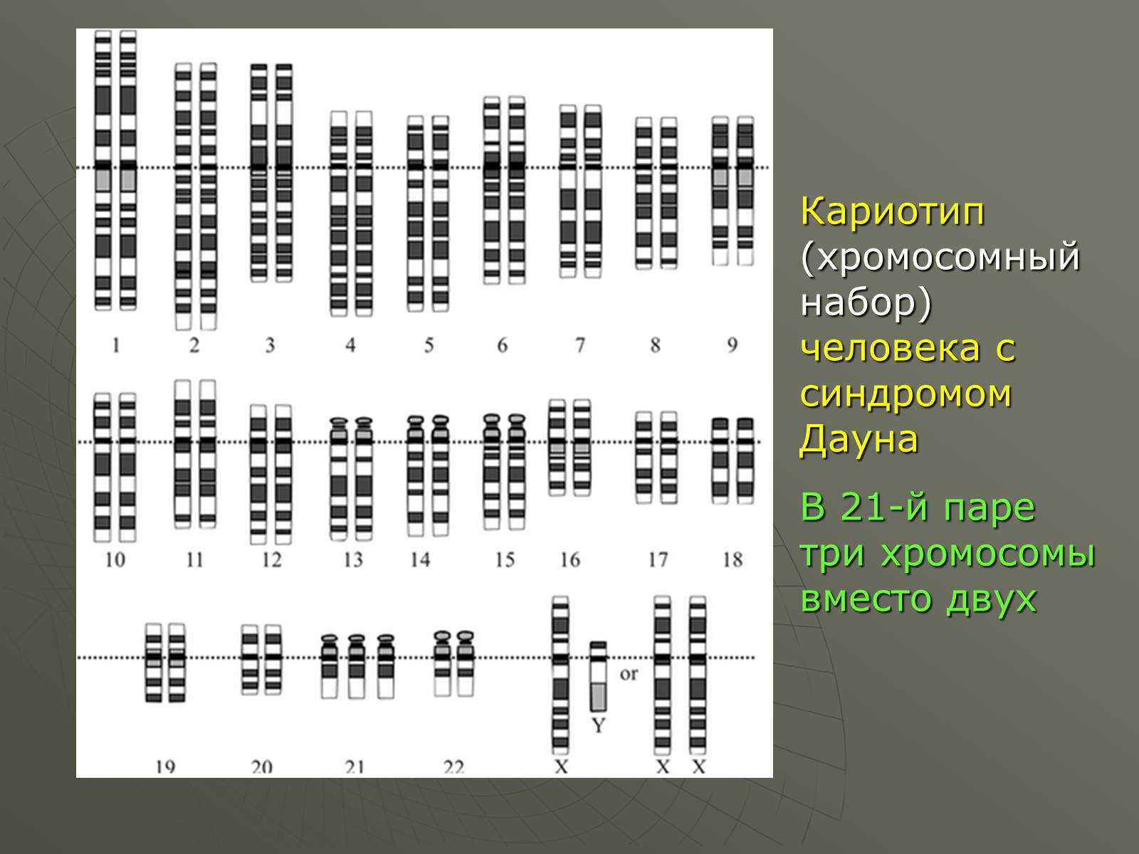 Синдром дауна лишняя хромосома. Кариотип человека с синдромом Дауна. Хромосомный набор кариотип человека. Набор хромосом при синдроме Дауна. Кариотип человека при синдроме Дауна.